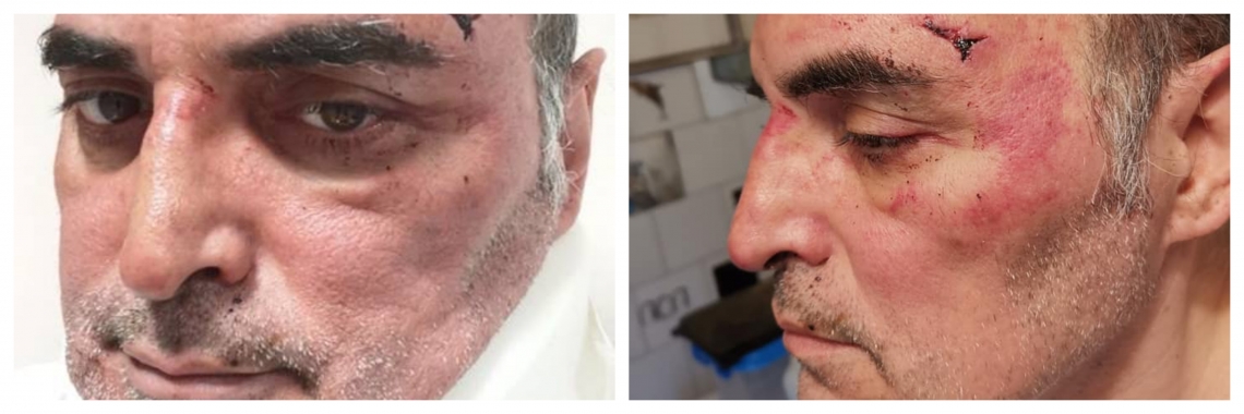 Aggredito con calci e pugni da dieci condomini “Brutto ricchione ti ammazziamo” – L’incredibile episodio a Torino