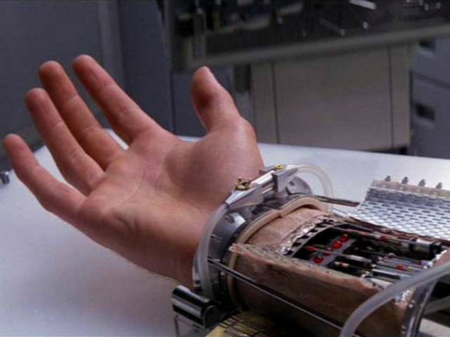 All’ospedale con la mano tranciata di netto – A Torino riescono a riattaccarla