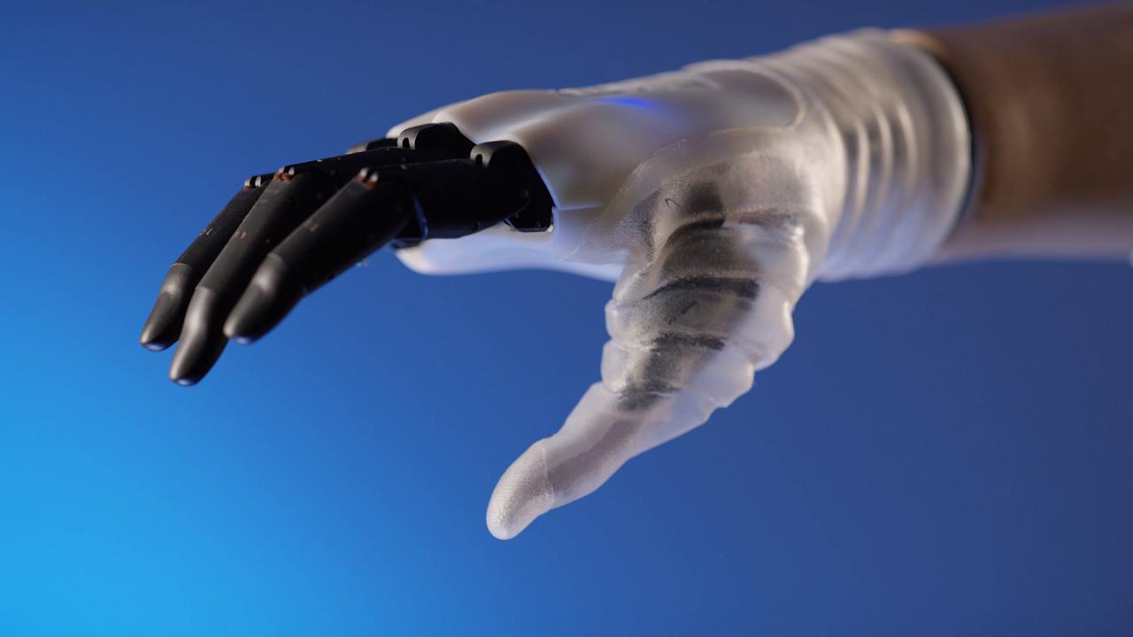 Torino – Super intervento al Maria Adelaide: mano bionica a 18enne che aveva perso le dita in incidente