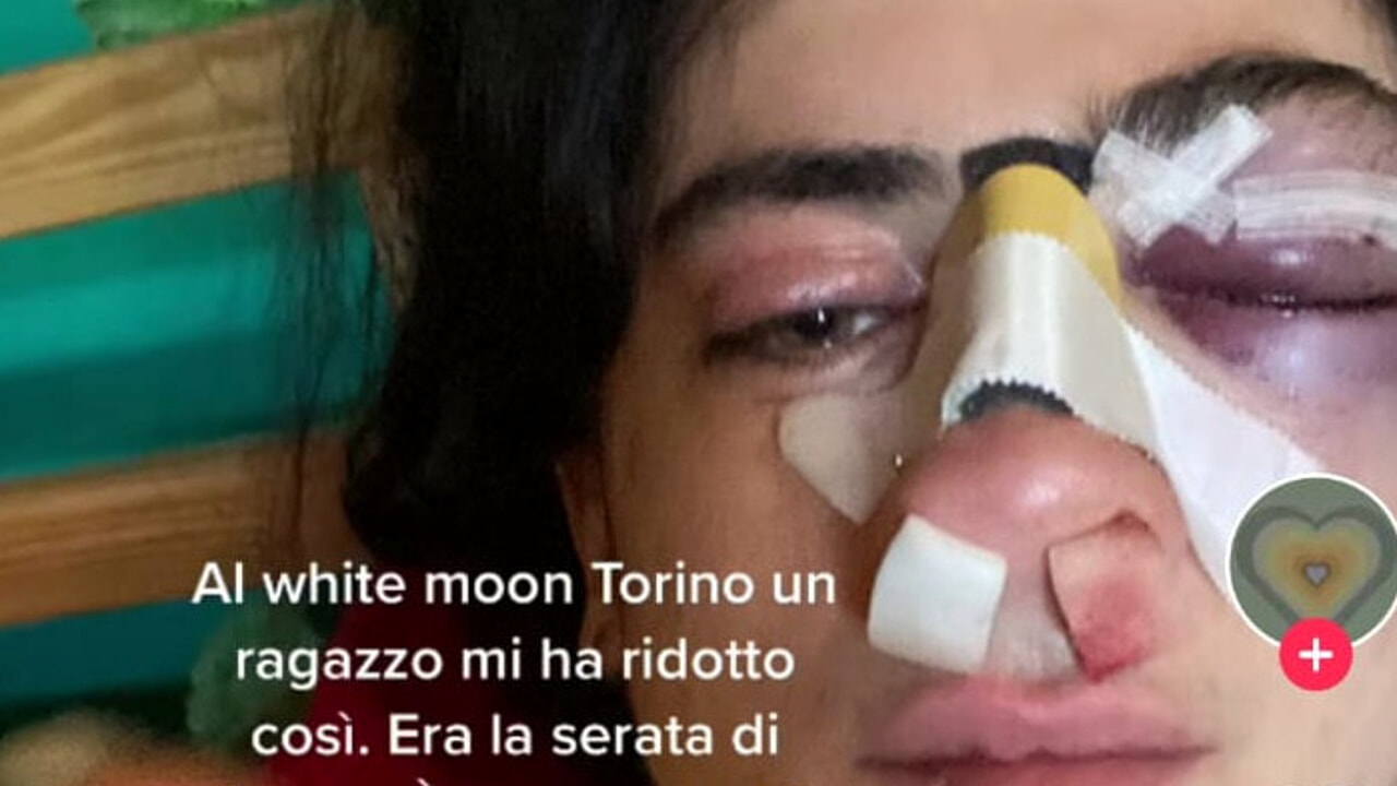 Torino – Folle aggressione a Santa Rita. Spacca il naso ad una ragazza con un pugno: il suo compagno aveva i capelli troppo lunghi