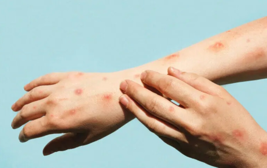 Torino -Vaiolo delle scimmie: iniziate le vaccinazioni per i soggetti a rischio