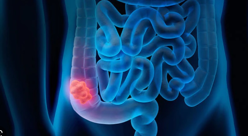 Grande scoperta dell’Università di Torino e Milano – Trovato il ‘punto debole’ del tumore al colon “Ora è curabile”