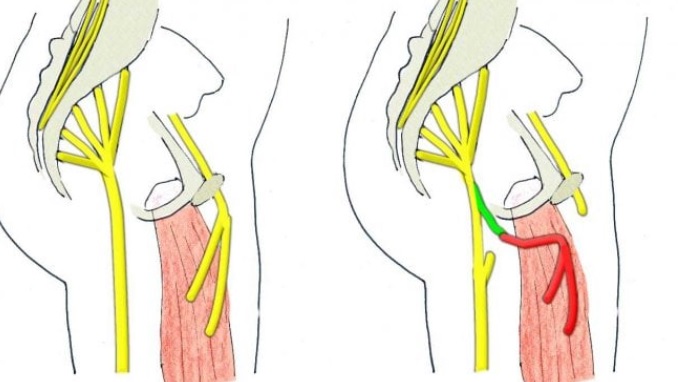 Torino – Grandioso intervento al Regina Margherita: trasferimento nervi, bimbo di 2 anni recupera gamba. E’ la prima volta in Europa